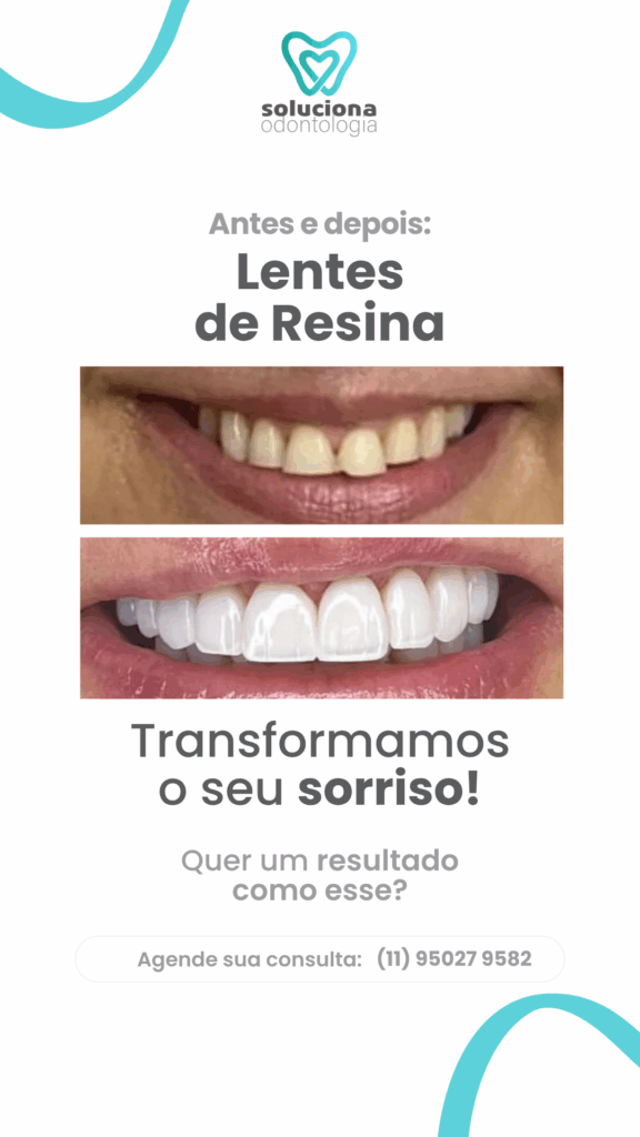 lente de contato dental
